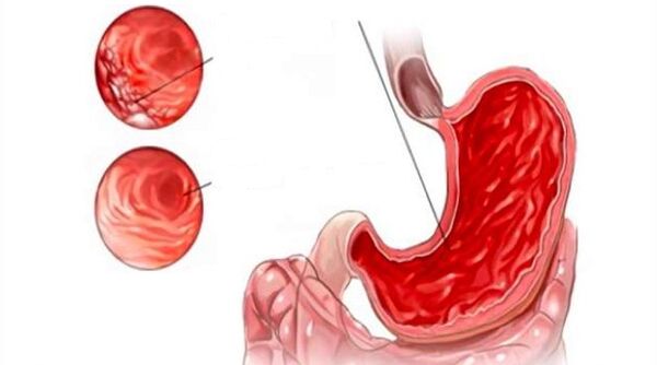 damage to the gastric mucosa during alcohol consumption